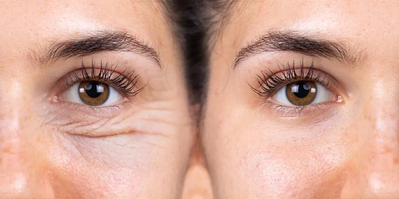 Blefaroplastia